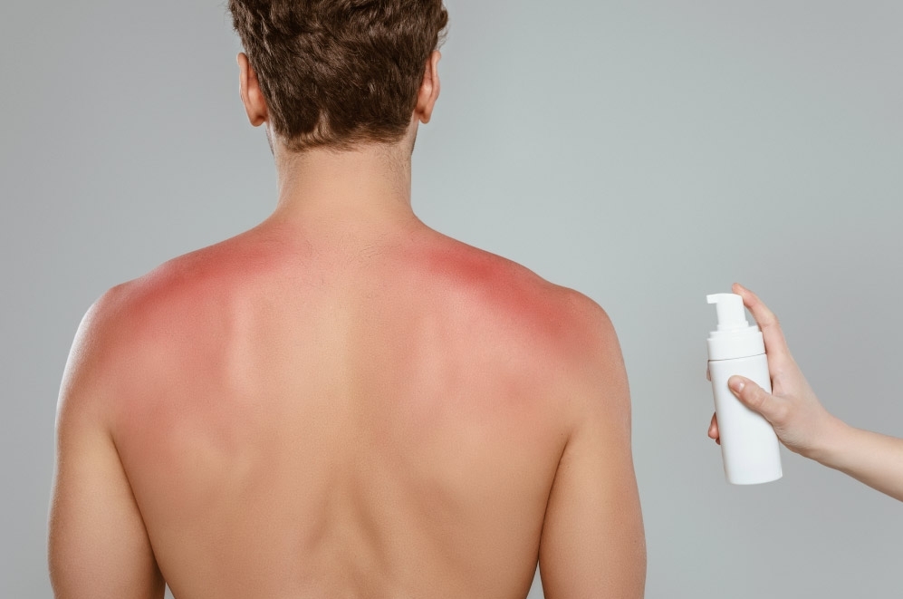 ¡Quemadura solar: Qué hacer y qué no cuando el sol nos lastima la piel!